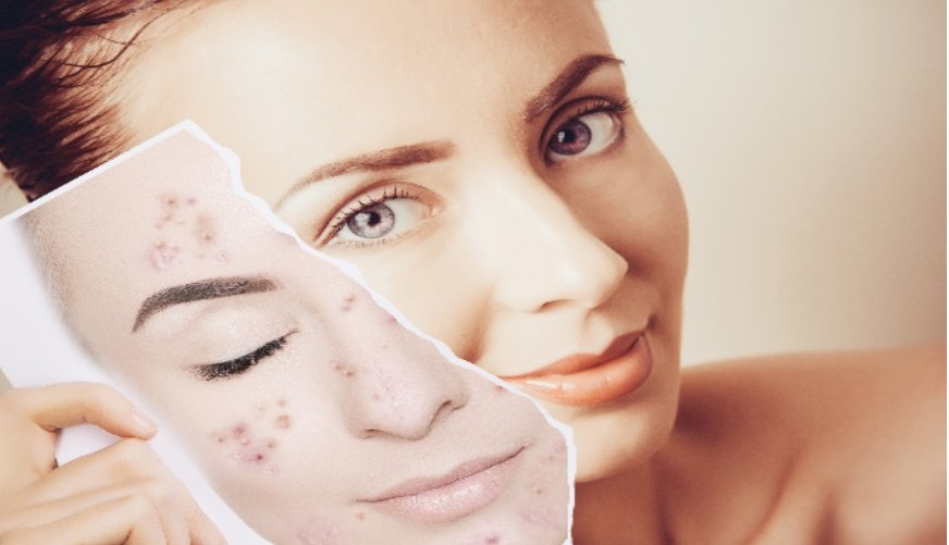 ตำรับยาไทย ใช้รักษาสิว ตำรับยาไทย ใช้รักษาสิว