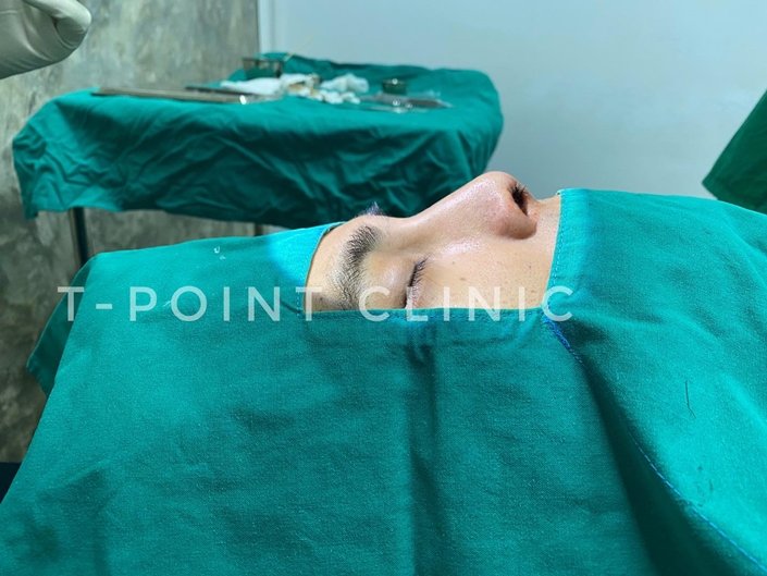 ความแตกต่างระหว่าง การศัลยกรรมจมูกในผู้ชาย และผู้หญิง ความแตกต่างระหว่าง การศัลยกรรมจมูกในผู้ชาย และผู้หญิง