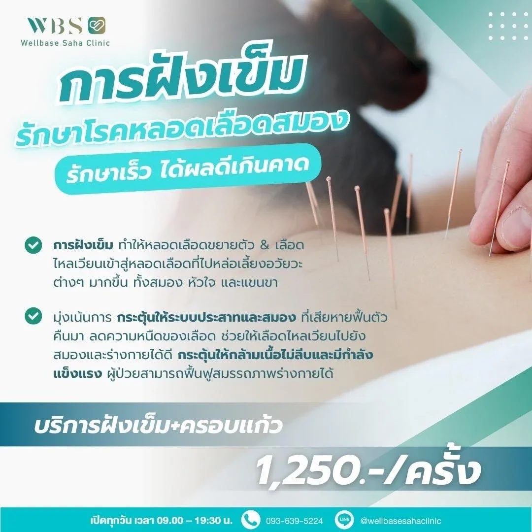 ฝังเข็มราคา