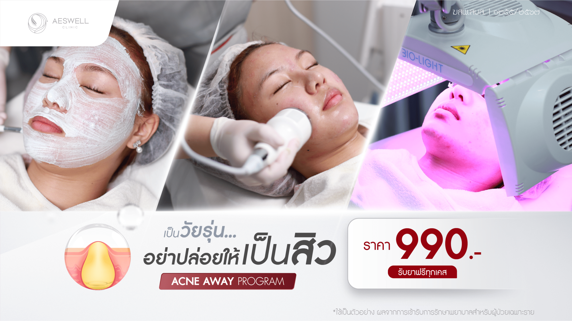 โปรโมชันรักษาสิว โปรโมชันรักษาสิว