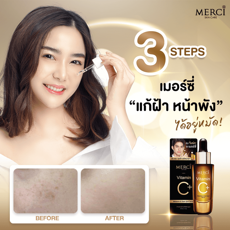 ฝ้าสะสม แก้ยาก แก้ด้วย เมอร์ซี่ เซรั่มฝ้า ฝ้าสะสม แก้ยาก แก้ด้วย เมอร์ซี่ เซรั่มฝ้า