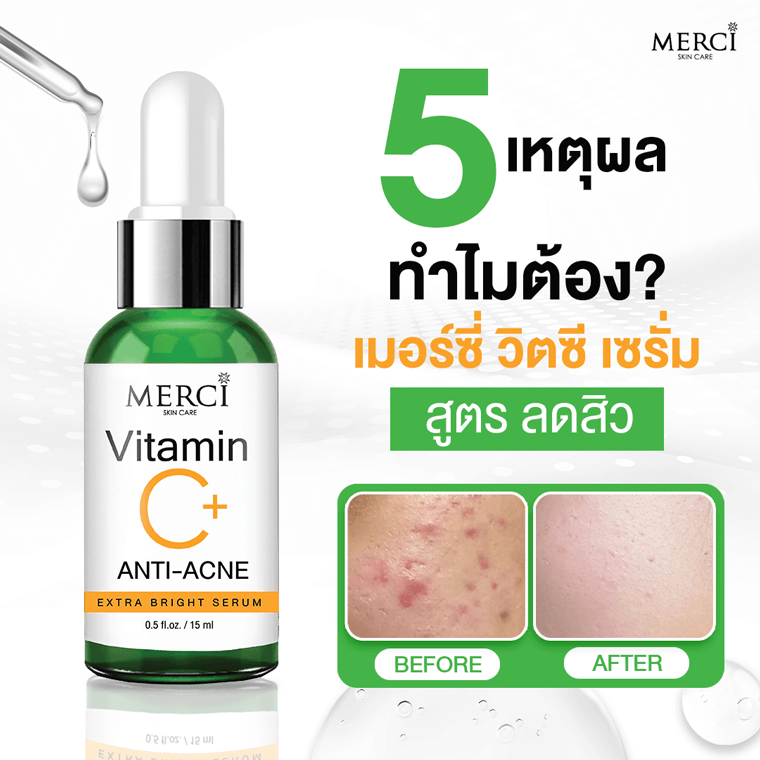 5 เหตุผล ทำไมต้อง “เมอร์ซี่ เซรั่ม สูตรลดสิว” 5 เหตุผล ทำไมต้อง “เมอร์ซี่ เซรั่ม สูตรลดสิว”