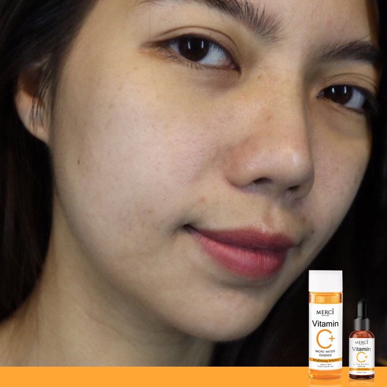 อัพผิวสวยขั้นสุด ด้วยเมอร์ซี่ เซรั่มวิตซี และน้ำตบลดสิว เวิร์คจริงไหม? อัพผิวสวยขั้นสุด ด้วยเมอร์ซี่ เซรั่มวิตซี และน้ำตบลดสิว เวิร์คจริงไหม?