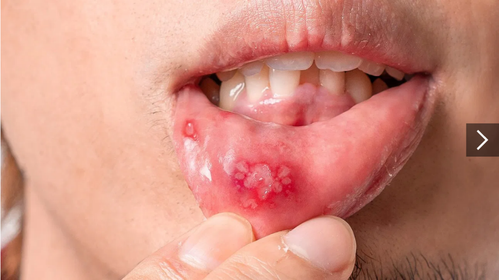 ร้อนในกี่วันจะหาย ยารักษาร้อนในหายไว