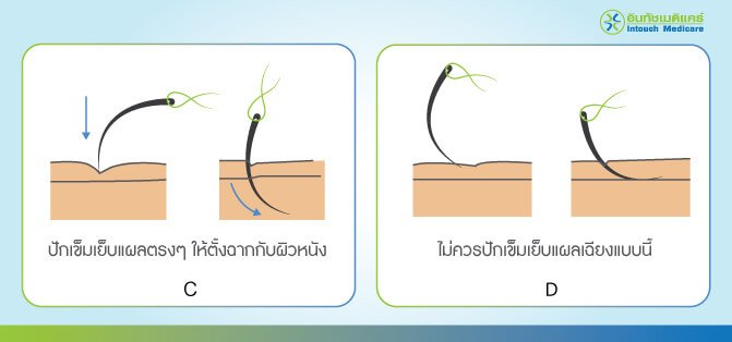 การปักเข็มเย็บแผล การปักเข็มเย็บแผล