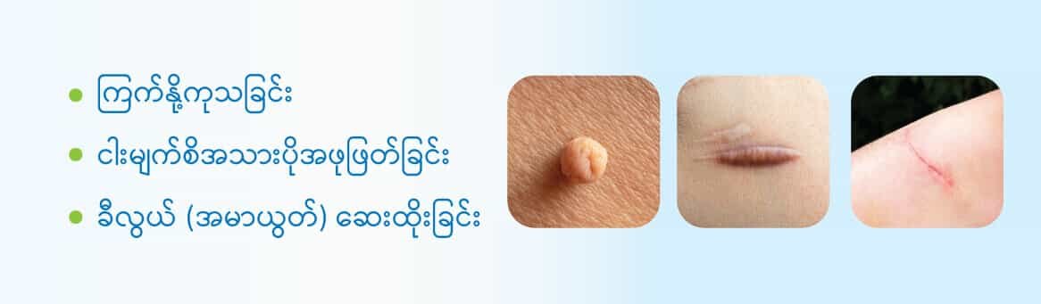 Wart-pendant-keloid-injection-polyp-removal ကြက်နို့ကုသခြင်း ငါးမျက်စိအသားပိုအဖုဖြတ်ခြင်း ခီလွယ် (အမာယွတ်) ဆေးထိုးခြင်း