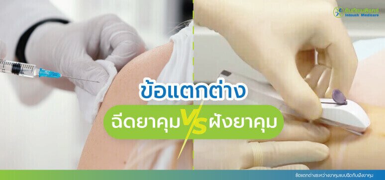 ข้อแตกต่างระหว่างยาคุมแบบฉีดกับฝังยาคุม