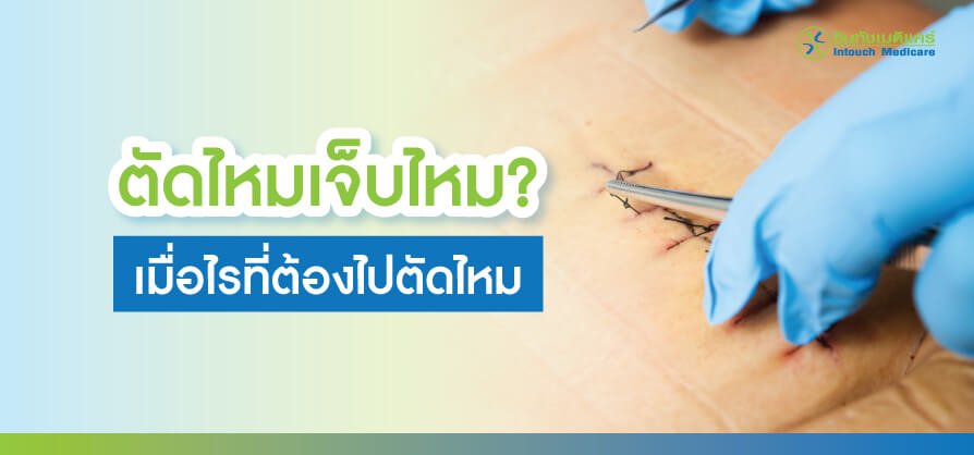 stitch-off ตัดไหม