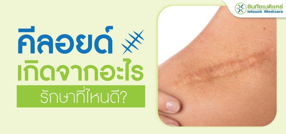 คีลอยด์ คีลอยด์