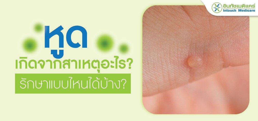 หูด หูด