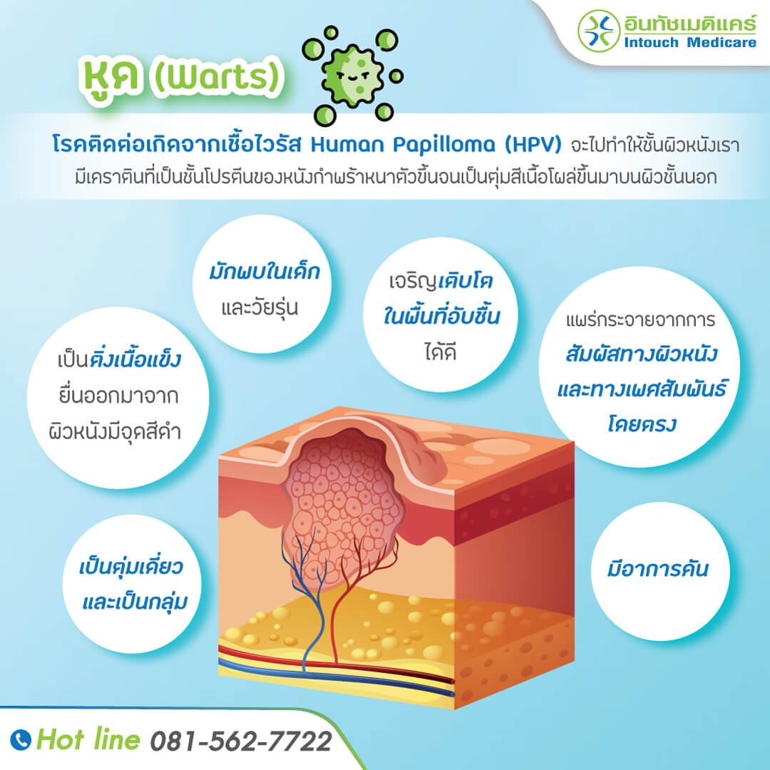 หูด หูด