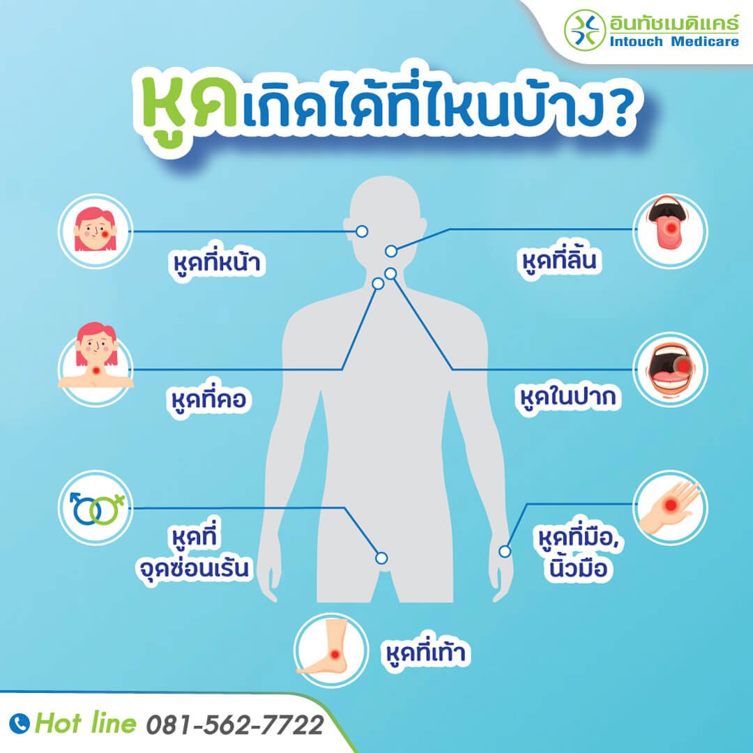 หูด บริเวิณที่เกิดหูด