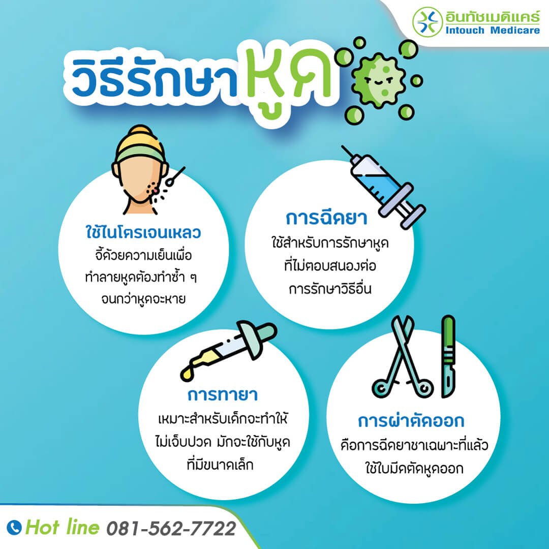 หูด การรักษาหูด