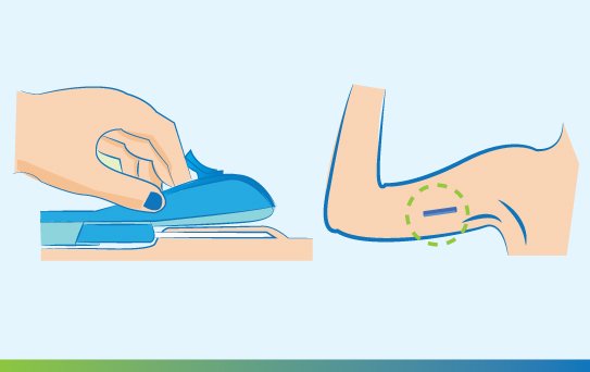 การคุมกำเนิดด้วยการฝังยาคุม การคุมกำเนิดด้วยการฝังยาคุม