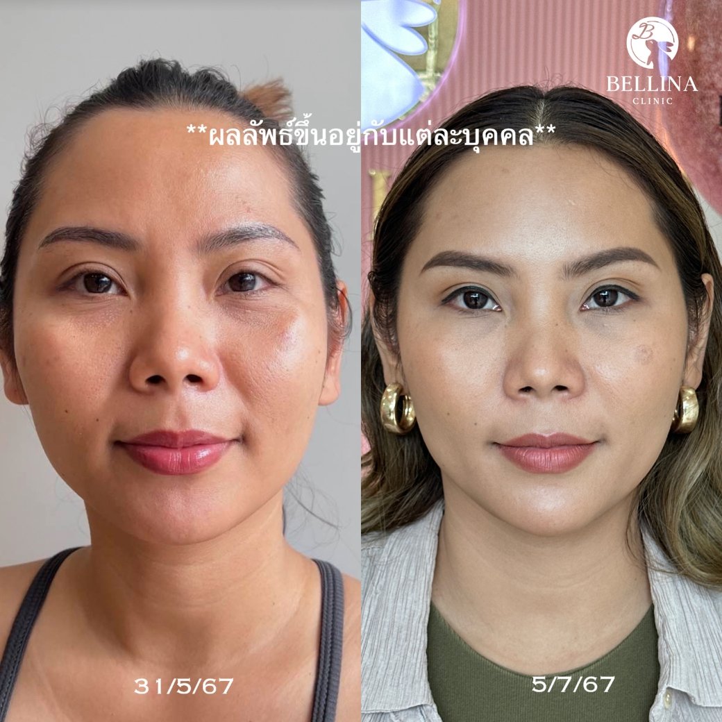 HIFU Linear firm ยกกระชับใบหน้า HIFU Linear firm ยกกระชับใบหน้า