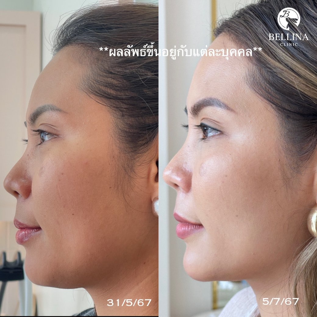 HIFU Linear firm ยกกระชับใบหน้า HIFU Linear firm ยกกระชับใบหน้า