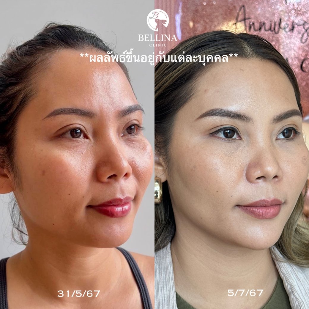 HIFU Linear firm ยกกระชับใบหน้า HIFU Linear firm ยกกระชับใบหน้า