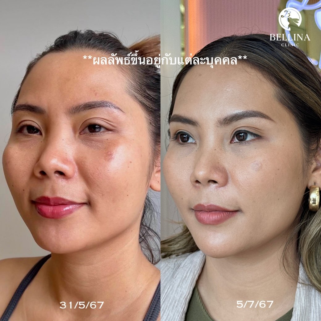 HIFU Linear firm ยกกระชับใบหน้า HIFU Linear firm ยกกระชับใบหน้า