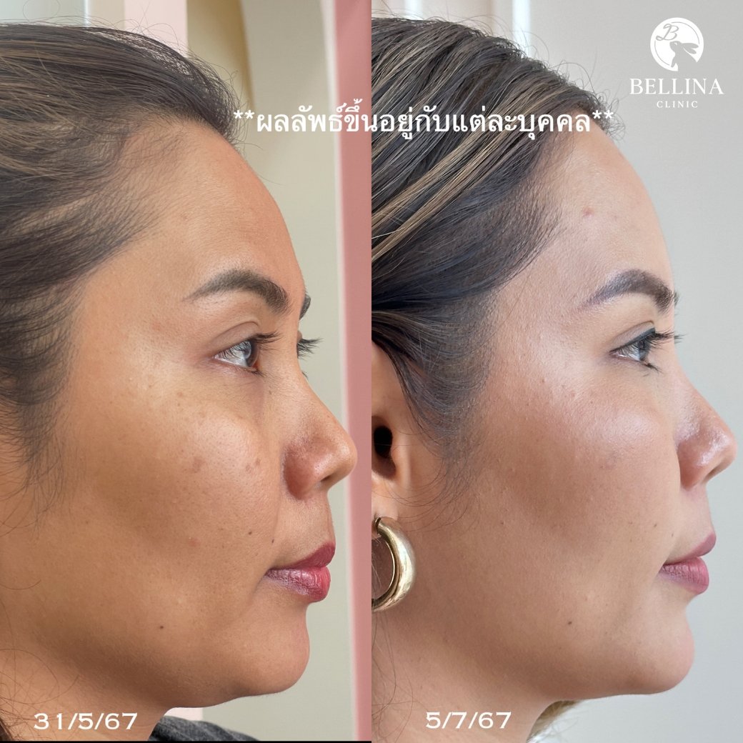 HIFU Linear firm ยกกระชับใบหน้า HIFU Linear firm ยกกระชับใบหน้า