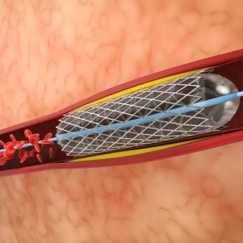 ืการทำบอลลูน ืการทำบอลลูน