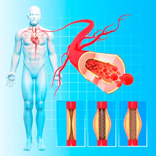 แนวทางการรักษาโรคหลอดเลือดหัวใจ