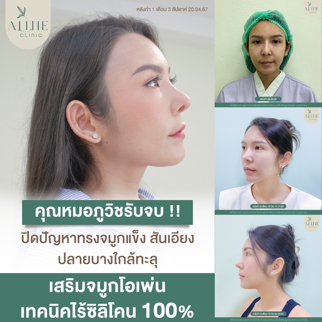 แก้จมูกโอเพ่นไร้ซิลิโคน แก้จมูกโอเพ่นไร้ซิลิโคน