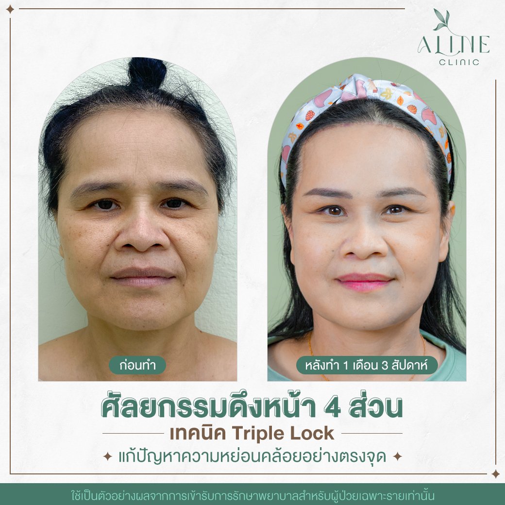 ดึงหน้า smas ดึงหน้า smas