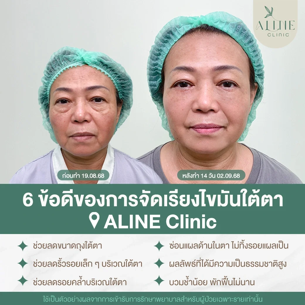 จัดเรียงไขมันใต้ตา