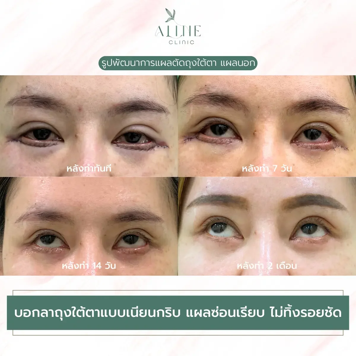 รีวิวตัดถุงใต้ตาแผลนอก