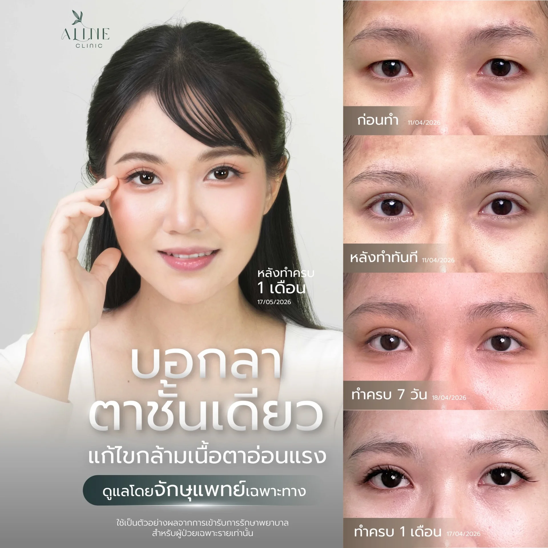 ทำตาสองชั้นโคราช ชั้นตาธรรมชาติ aline clinic ทำตาสองชั้นโคราช ชั้นตาธรรมชาติ aline clinic
