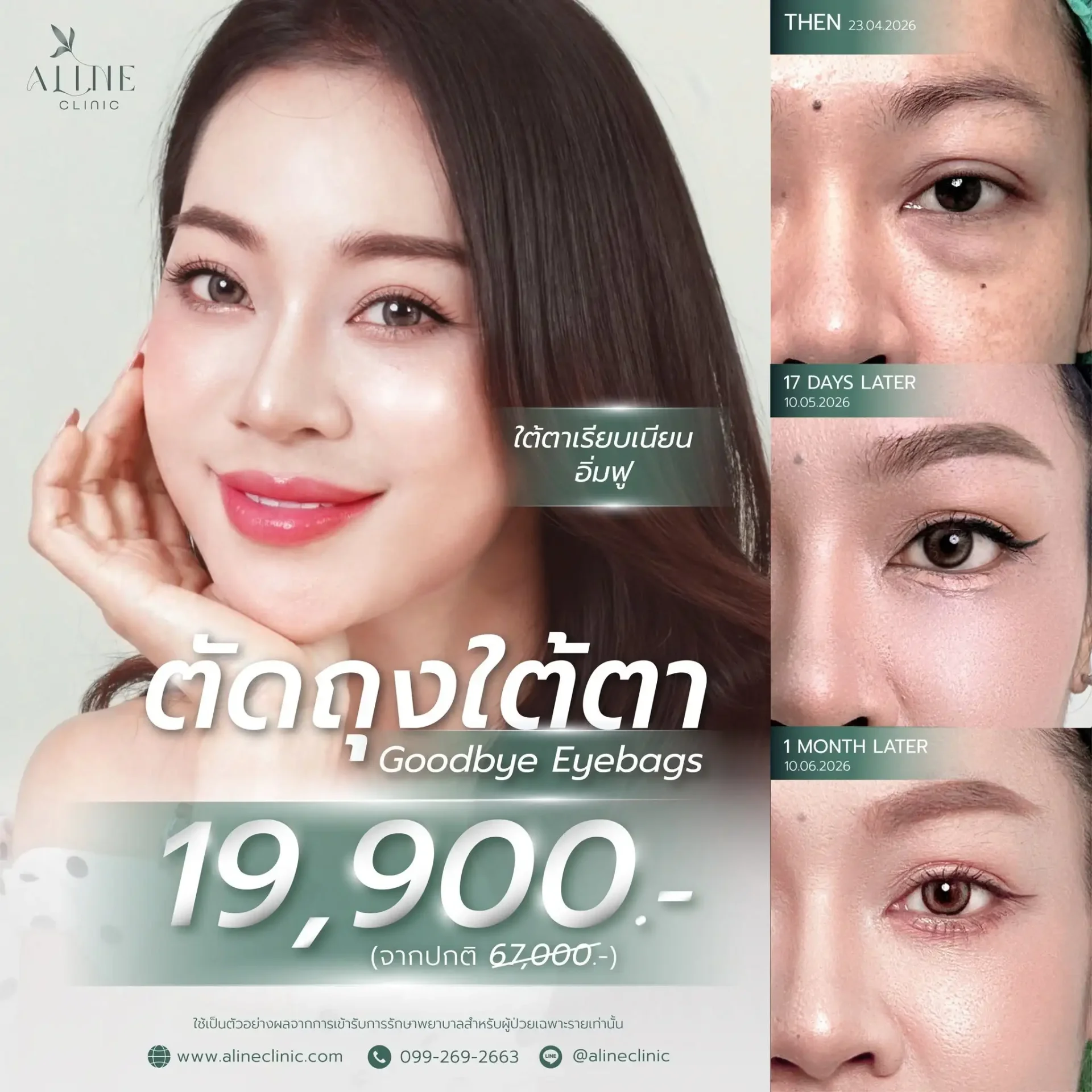 ตัดถุงใต้ตา ราคา โคราช aline clinic