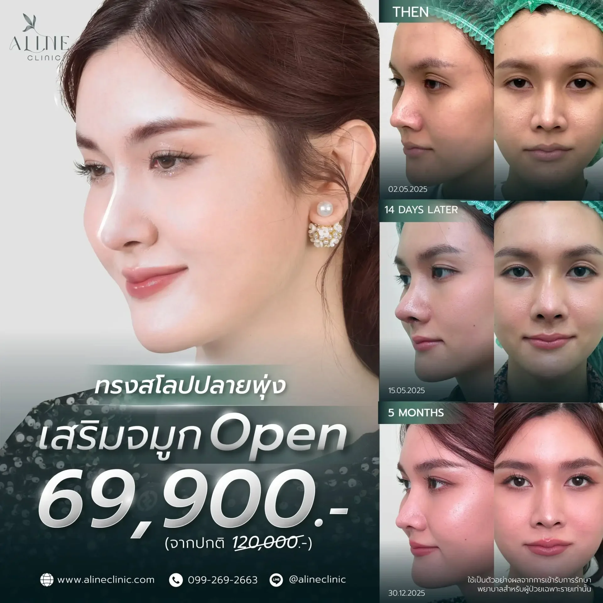เสริมจมูกโอเพ่น ราคา โคราช aline clinic
