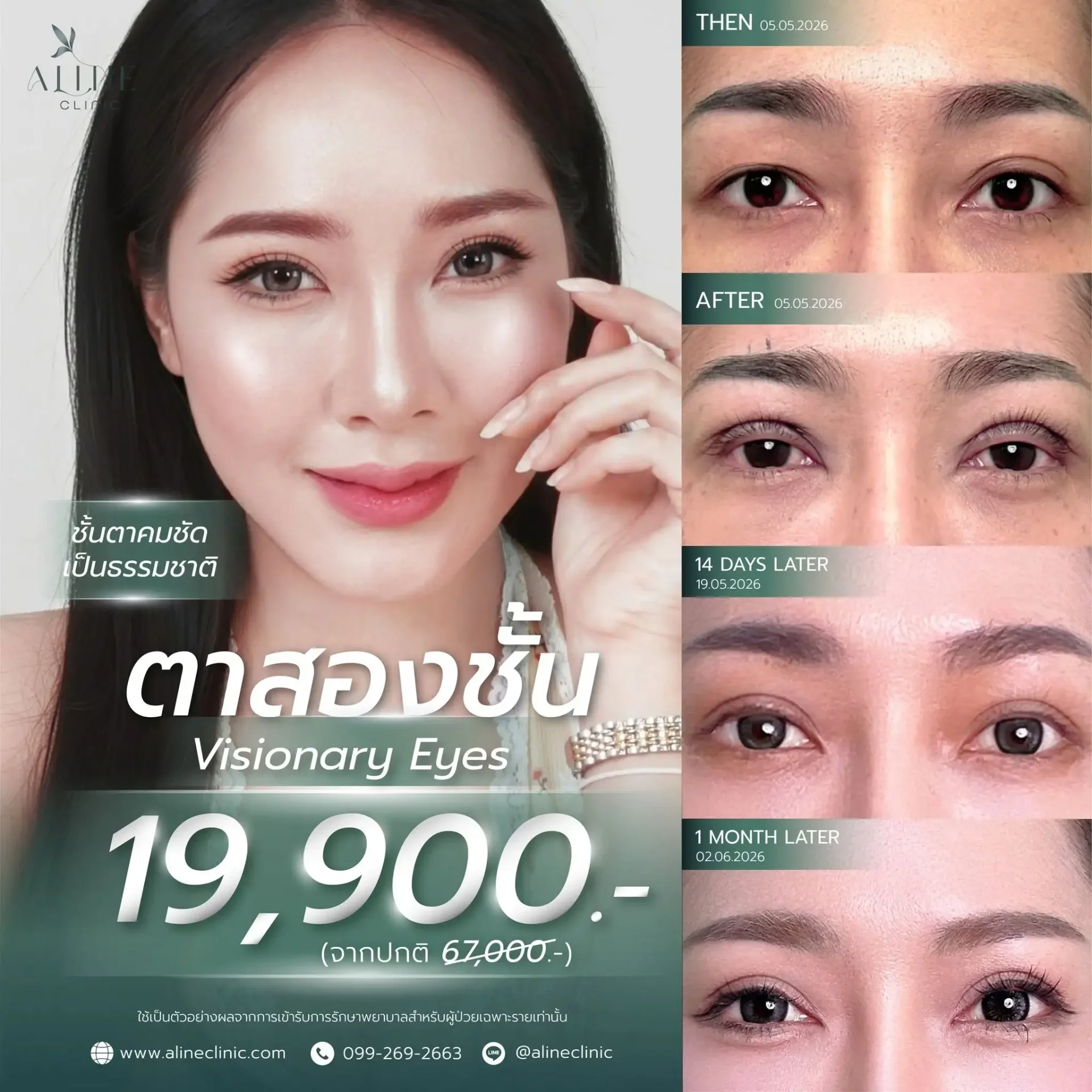 ตาสองชั้น ราคา โคราช aline clinic