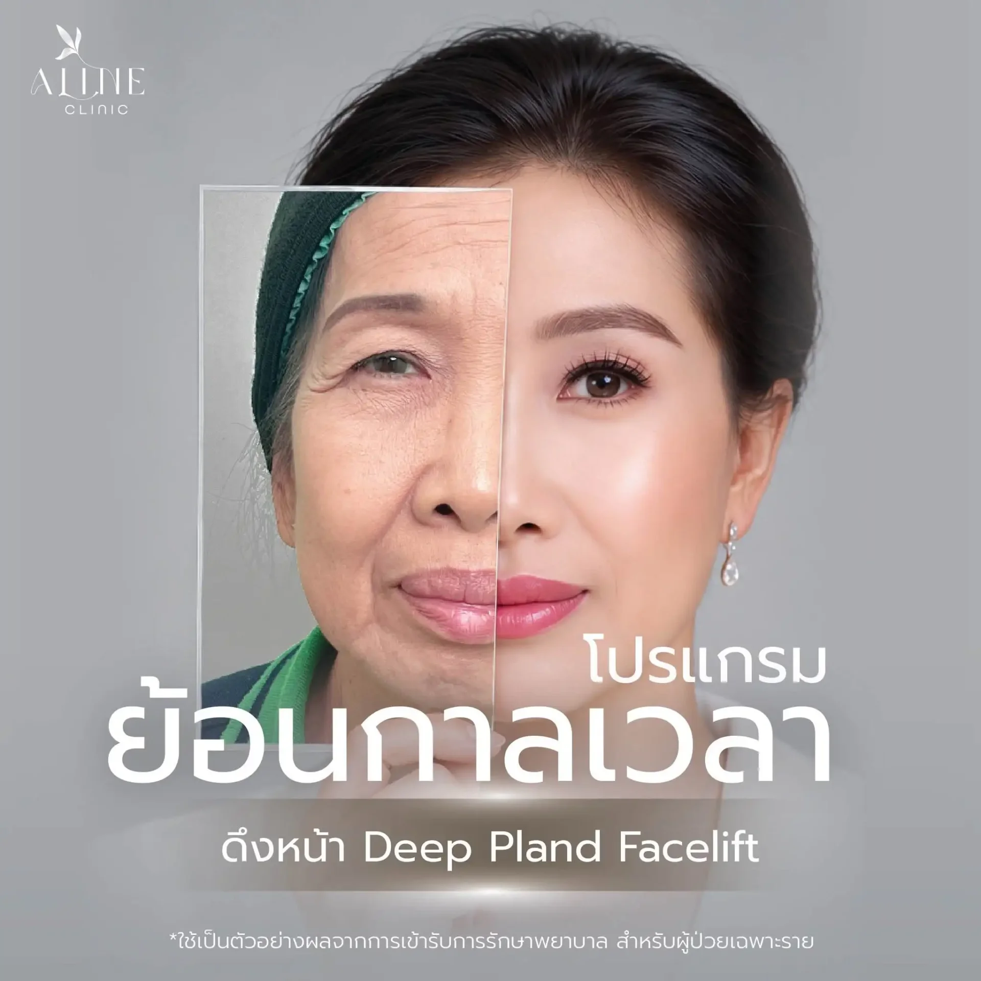 รีวิวดึงหน้าชั้นลึก ALINE Clinic โคราช รีวิวดึงหน้าชั้นลึก ALINE Clinic โคราช