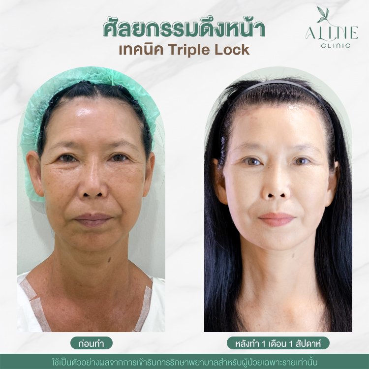 ดึงหน้า ดึงหน้า