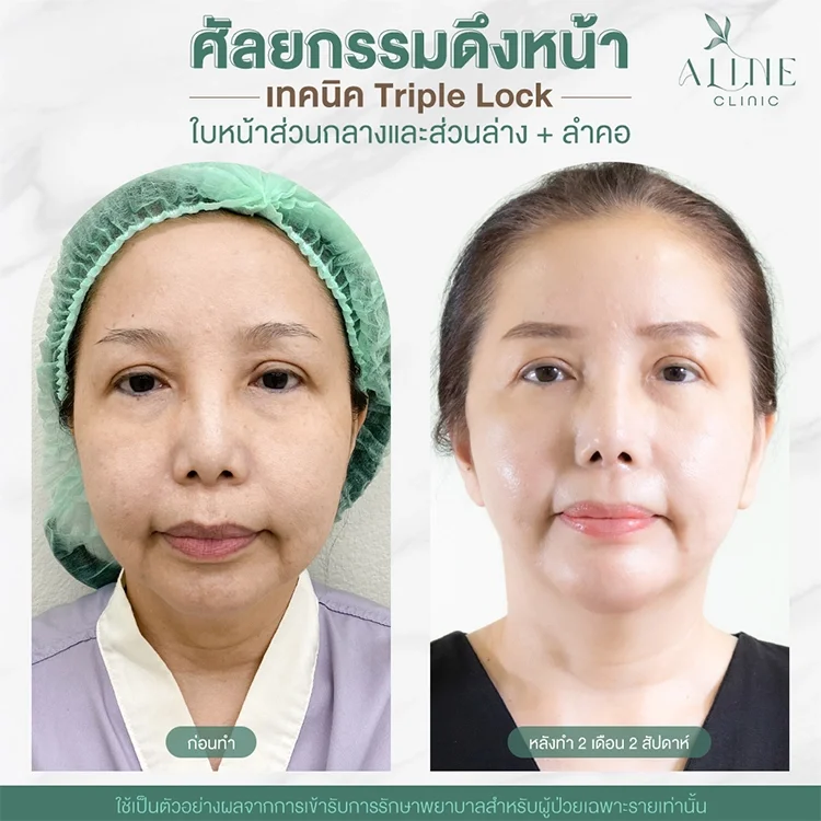 รีวิวดึงหน้า รีวิวดึงหน้า