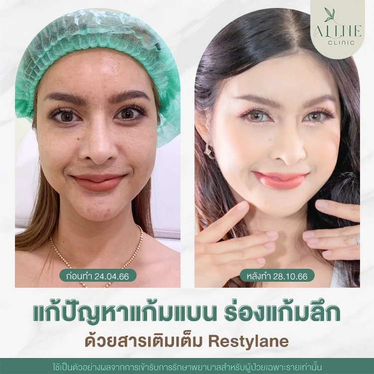 restylane