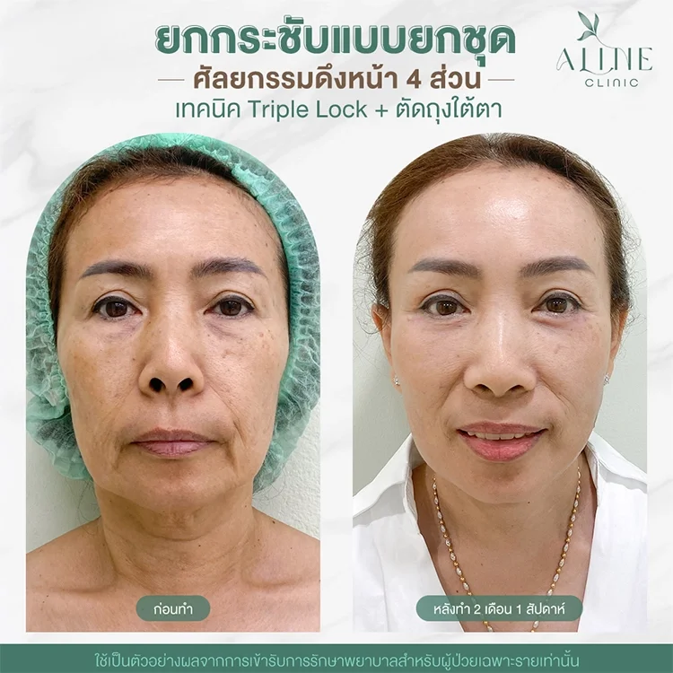 รีวิวดึงหน้า รีวิวดึงหน้า