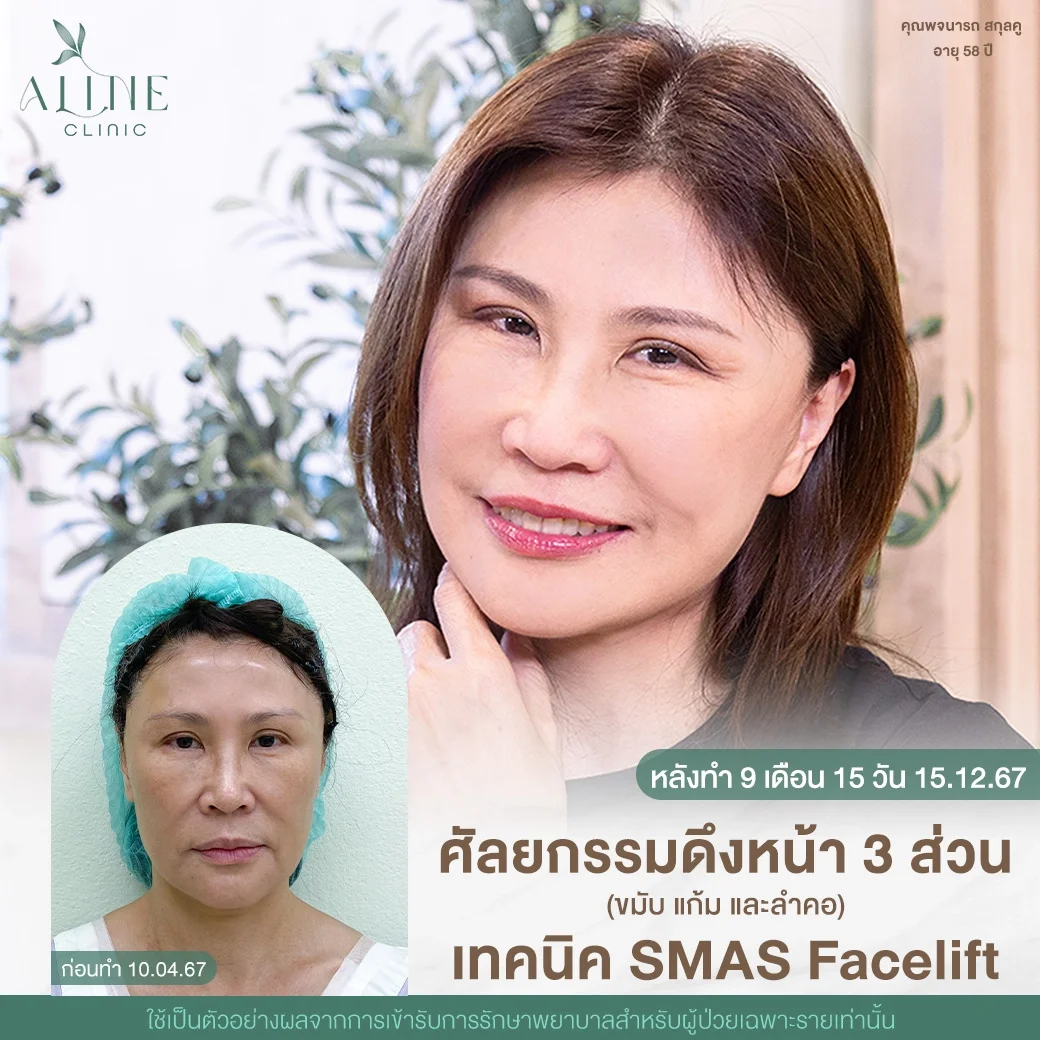 รีวิวดึงหน้าชั้นลึก SMAS