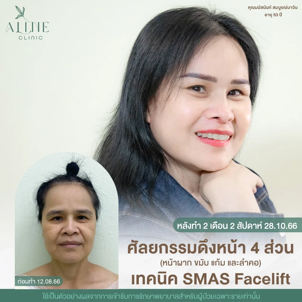 รีวิวดึงหน้า