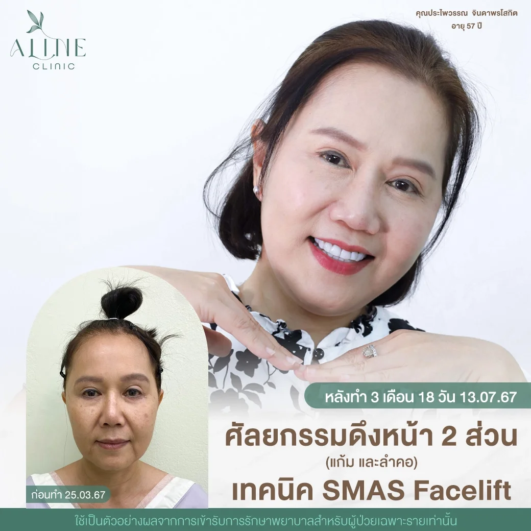 ดึงหน้า