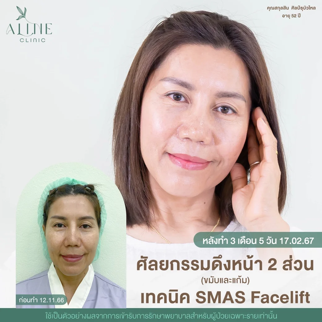 รีวิวดึงหน้าชั้นลึก SMAS