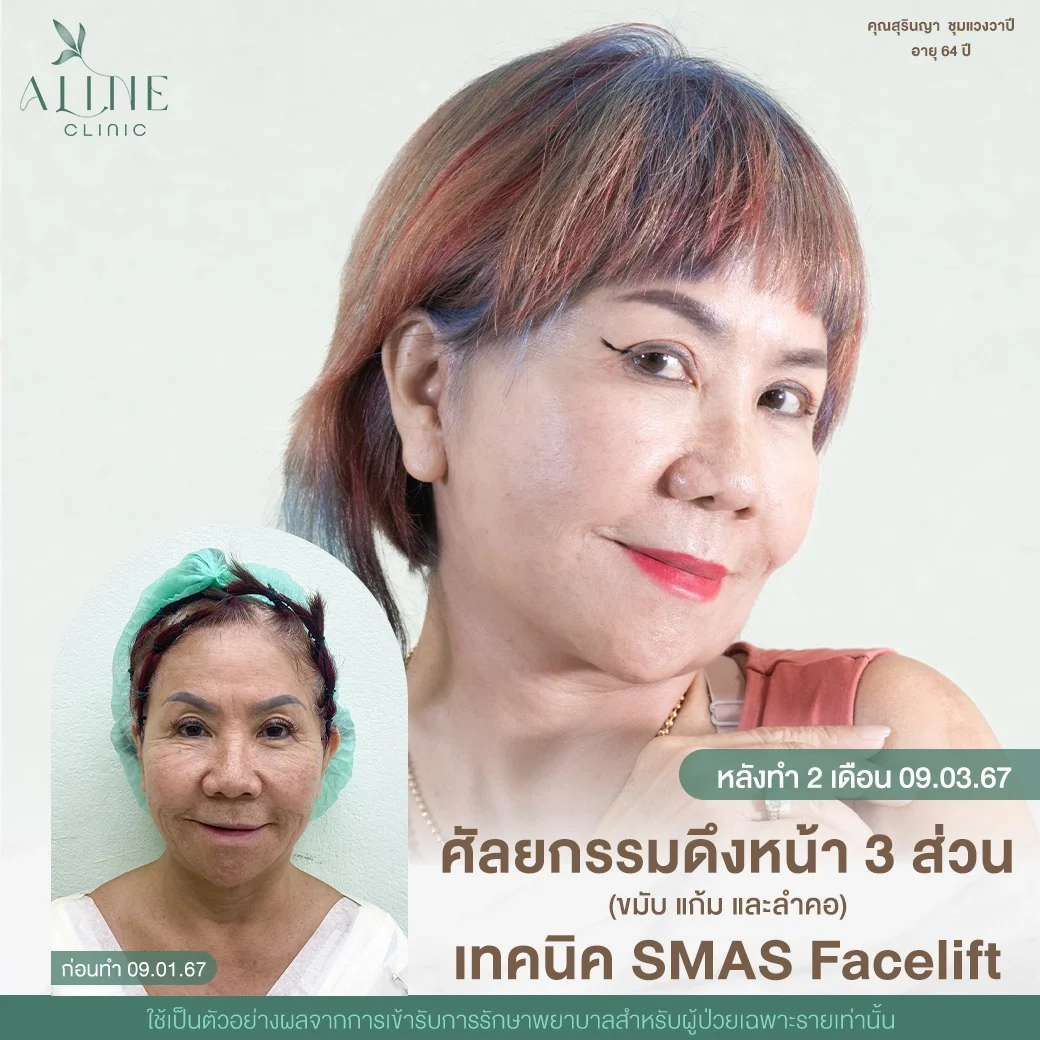 ดึงหน้า 3 ส่วน โคราช
