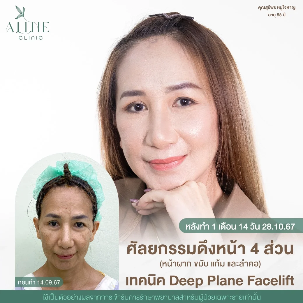deep plane facelift