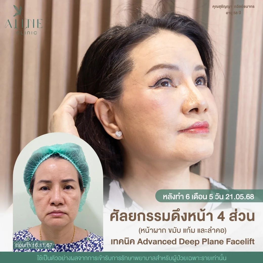 deep plane facelift