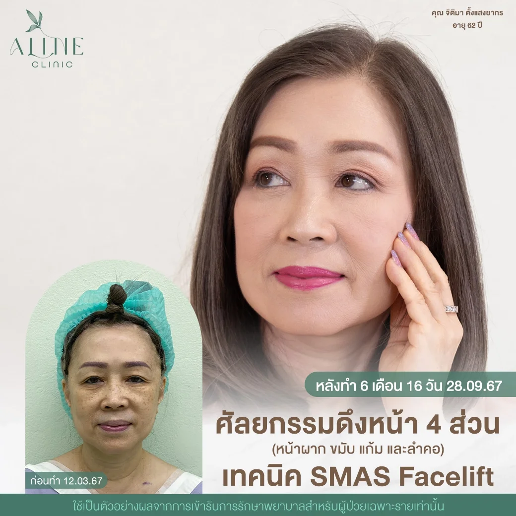 ดึงหน้า