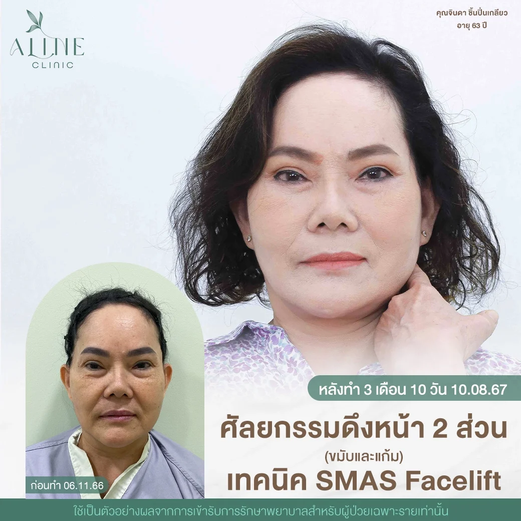 ดึงหน้า