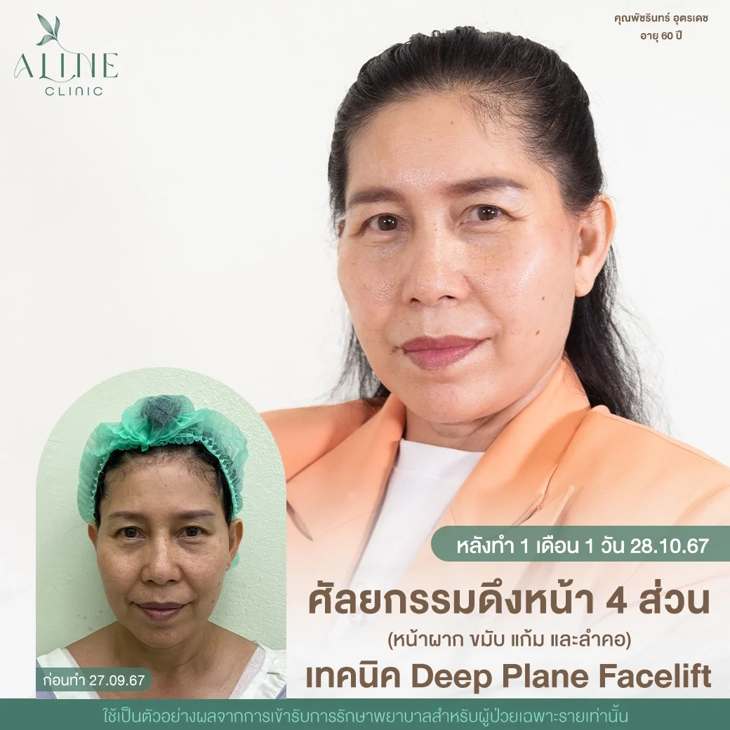 ดึงหน้า
