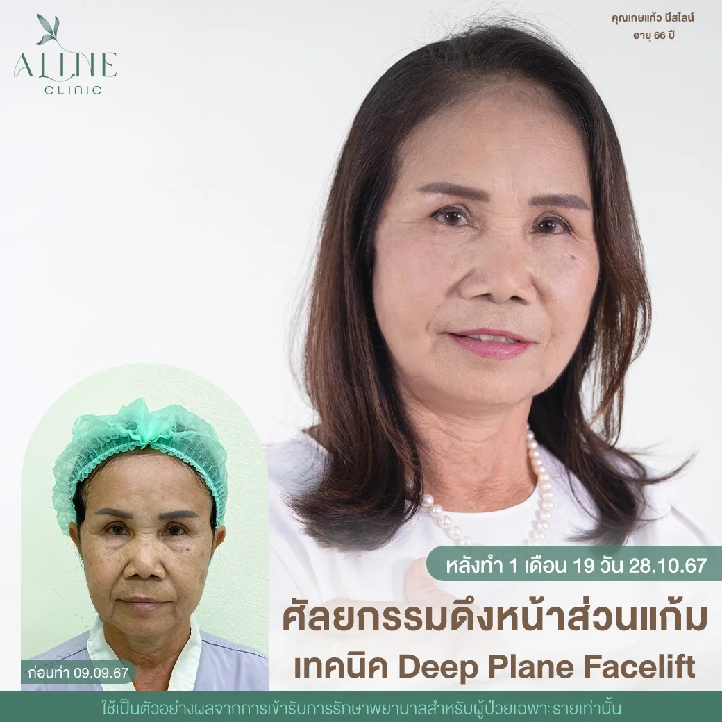 ดึงหน้า