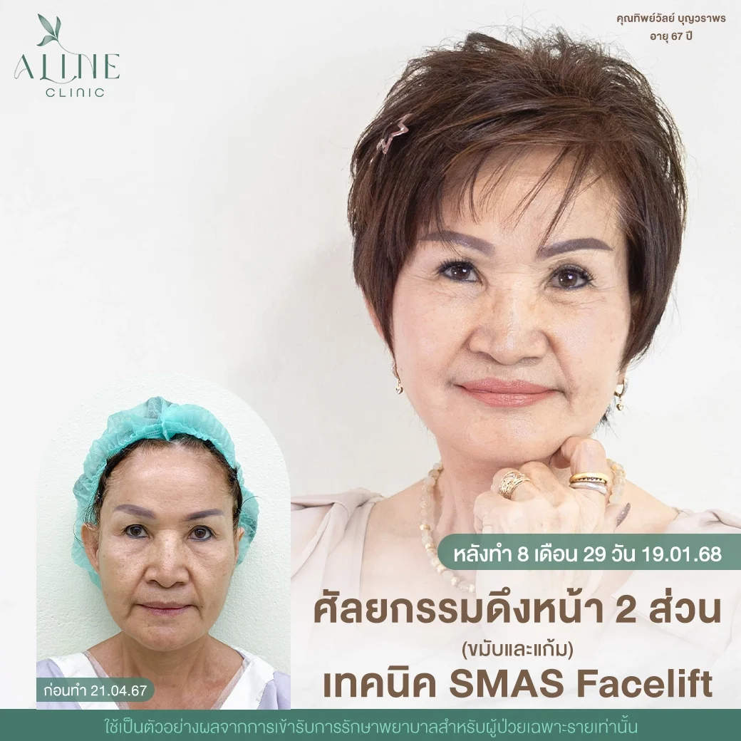 รีวิวดึงหน้า โคราช